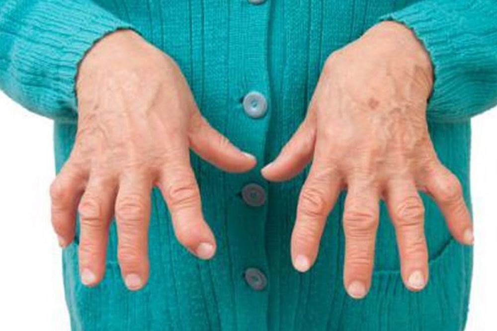 Darán charlas informativas sobre características y prevención de artritis reumatoidea