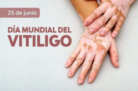 El 25 de junio es el Día Mundial del Vitiligo